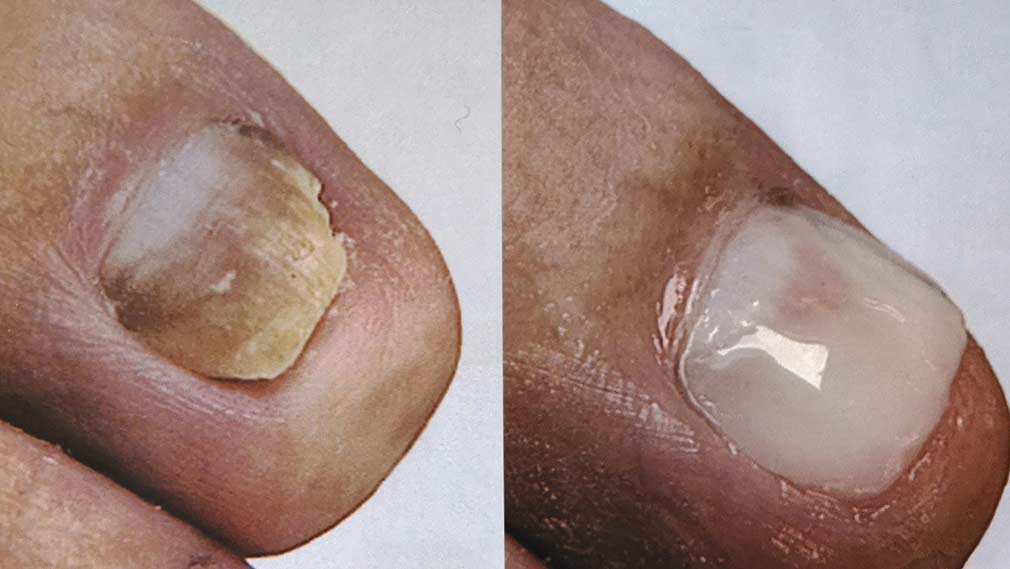 Nagelersatz / Nagelprothetik_Podologie-Ingelheim